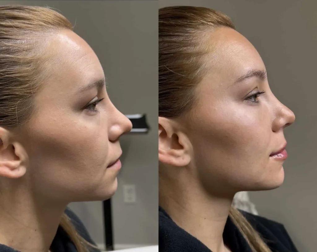 Facial Balancing in Tampa, FL by Kiyani Aesthetics
