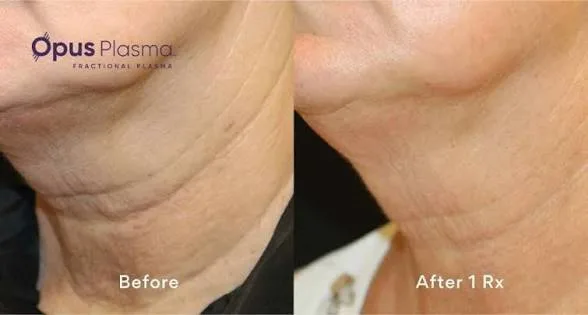OPUS™ Plasma Treatment before after